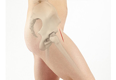 Anterior Hip Replacement 