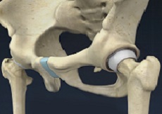 Hip Injury