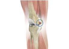 Knee Ligament Surgery