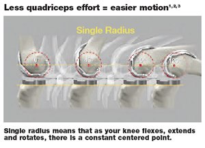 Knee Implants That Promote Easier Motion 1,2,3