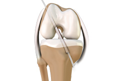 ACL Reconstruction