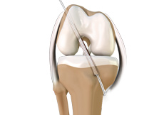 ACL surgery 