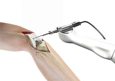 Computer Assisted Knee Replacement