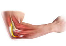 Cubital Tunnel Syndrome