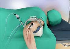 Elbow Arthroscopy