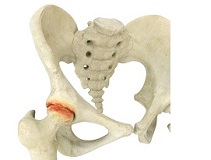 Hip Arthritis