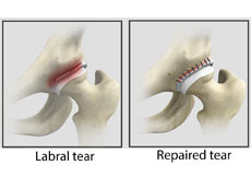 Hip Labral Repair