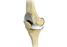 knee replacement 