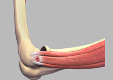 Lateral Epicondylitis