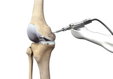 Mako Robotic Knee Replacement