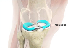 Meniscus Surgery