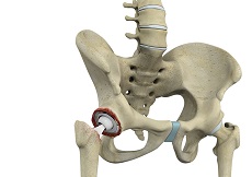 Revision Hip Replacement