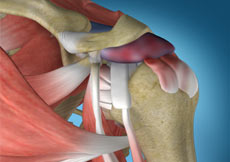 Shoulder Impingement