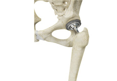 Total Hip Replacement THR