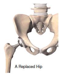 A Replaced Hip