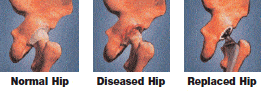 Hip