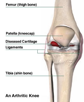 An Arthritic Knee