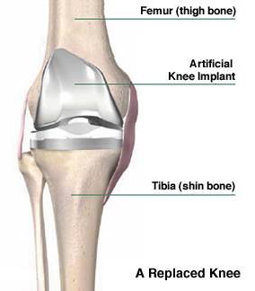 A Replaced Knee