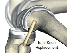 Total Knee Replacement